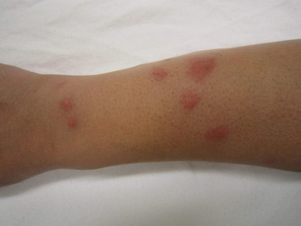 What Do Roach Bites Look Like